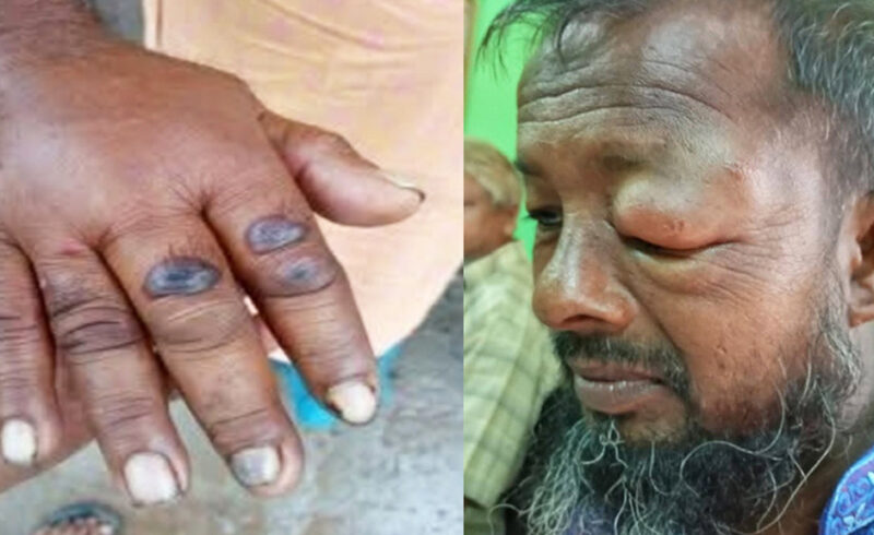 গাইবান্ধায় অ্যানথ্রাক্স আতঙ্ক সাত দিনে ১১ জন আক্রান্ত